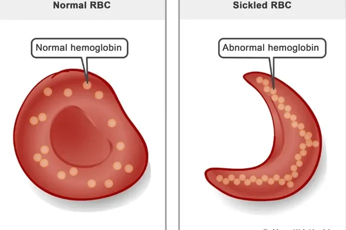 Sickle vs Normal RBC