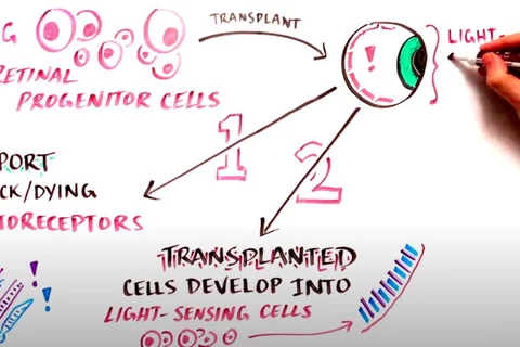 How stem cell research is changing the lives of patients with Retinitis Pigmentosa